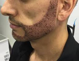 The Incredible Impact of a Beard Hair Transplant