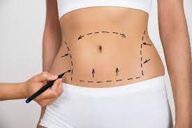 Transformative Results: Lipo Abdominoplasty